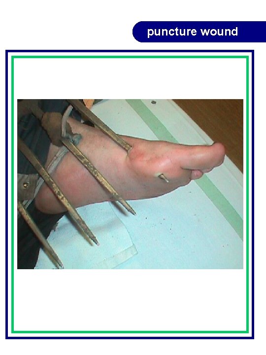 puncture wound puncture wound