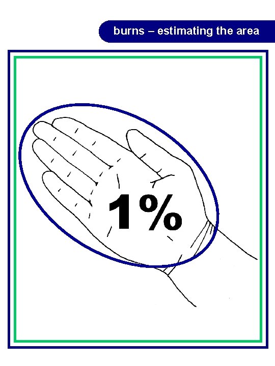 burns – estimating the area burns – estimating the area