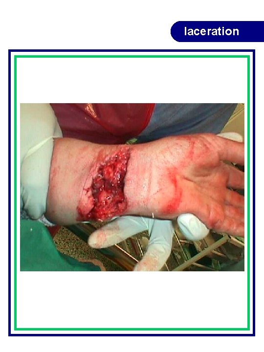 laceration laceration