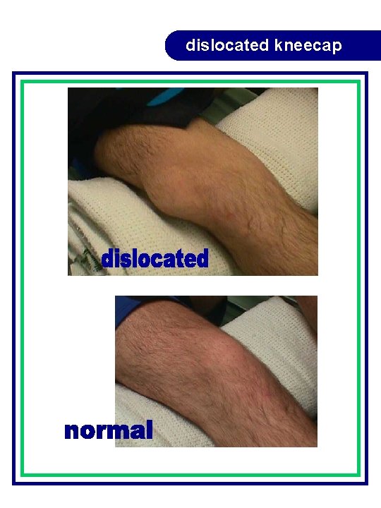 dislocated kneecap dislocated kneecap