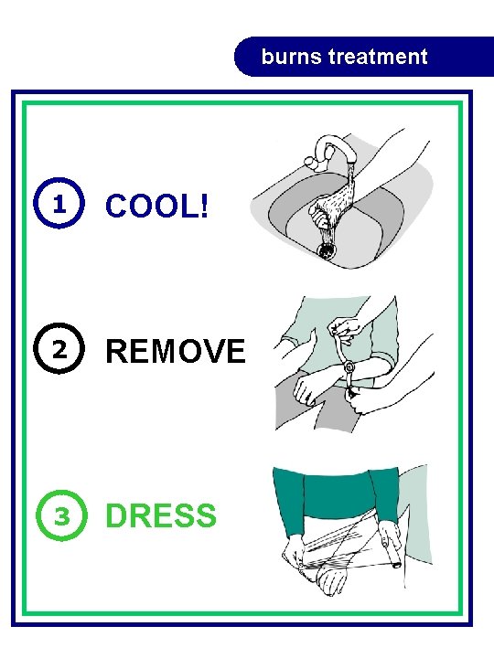burns treatment 1 COOL! 2 REMOVE 3 DRESS burns treatment 1 COOL! 2 REMOVE 3 DRESS