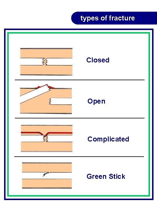 types of fracture Closed Open Complicated Green Stick types of fracture Closed Open Complicated Green Stick