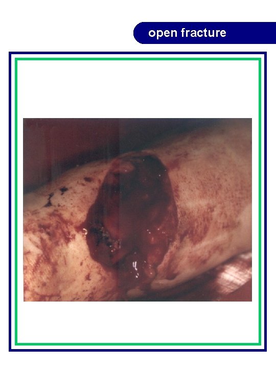 open fracture open fracture