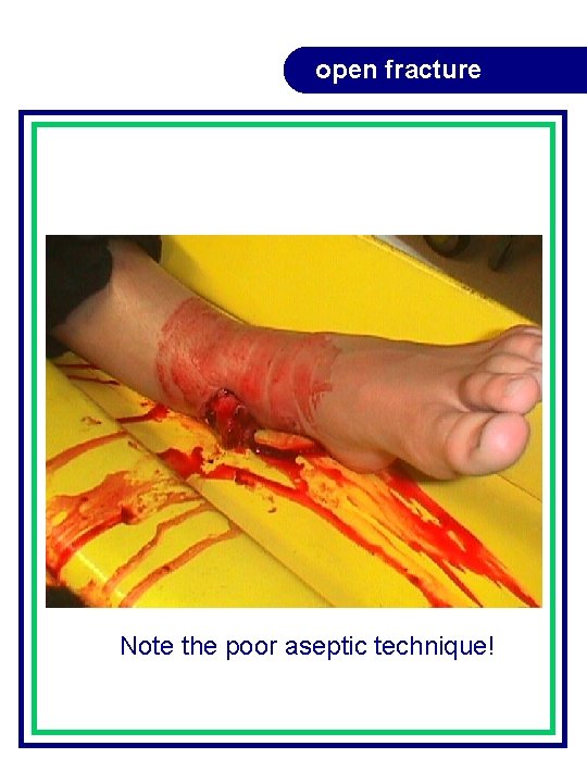 open fracture Note the poor aseptic technique! open fracture Note the poor aseptic technique!