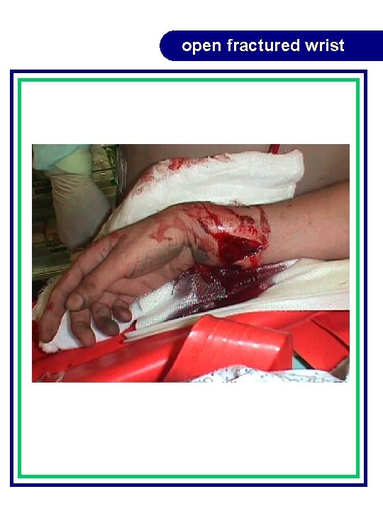 open fractured wrist open fractured wrist