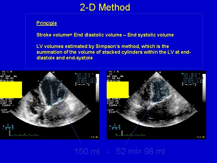 2 -D Method Principle Stroke volume= End diastolic volume – End systolic volume LV