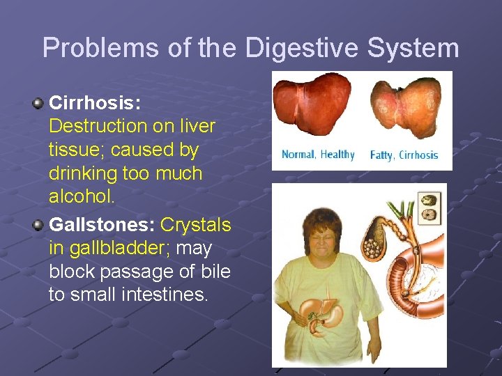 Problems of the Digestive System Cirrhosis: Destruction on liver tissue; caused by drinking too