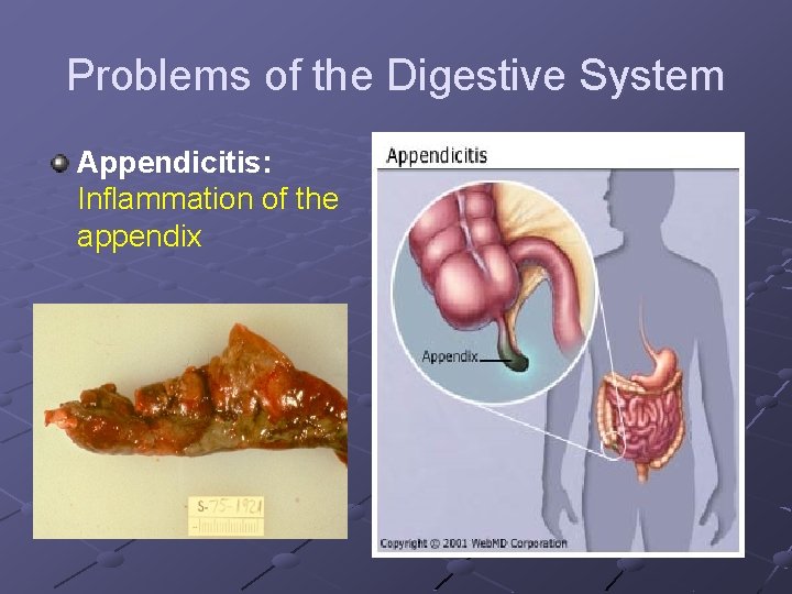Problems of the Digestive System Appendicitis: Inflammation of the appendix 