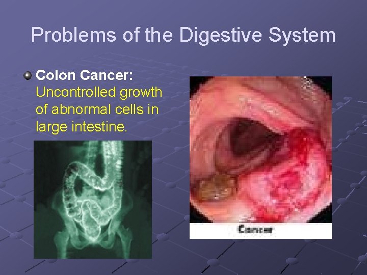 Problems of the Digestive System Colon Cancer: Uncontrolled growth of abnormal cells in large