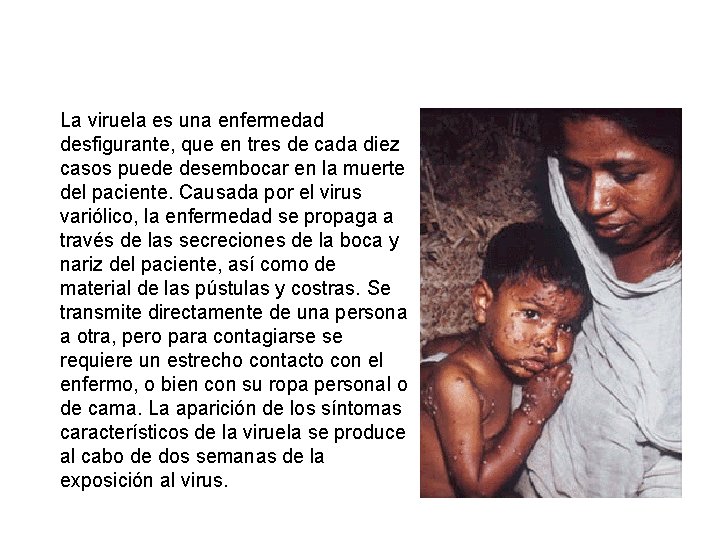 La viruela es una enfermedad desfigurante, que en tres de cada diez casos puede