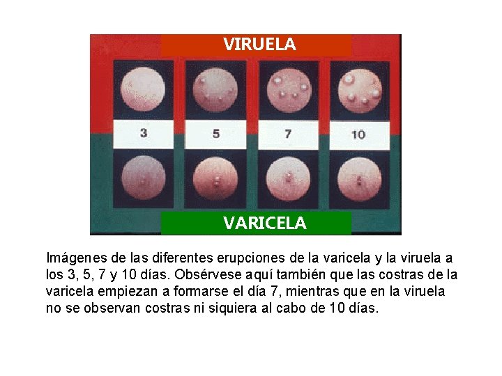 VIRUELA VARICELA Imágenes de las diferentes erupciones de la varicela y la viruela a