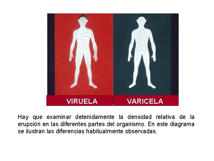 VIRUELA VARICELA Hay que examinar detenidamente la densidad relativa de la erupción en las