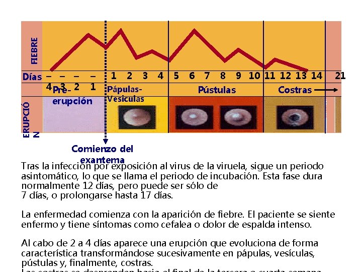 FIEBRE ERUPCIÓ N Días – – – 4 Pre 3 2 – 1 erupción