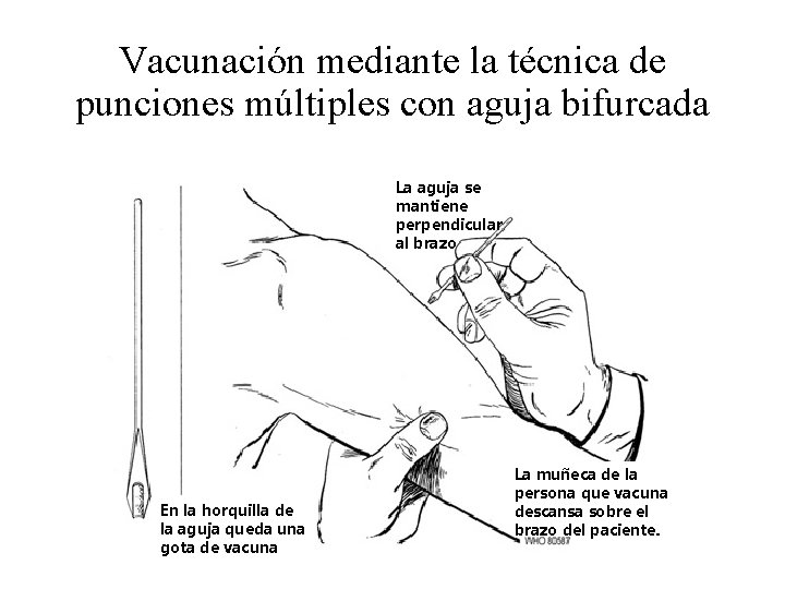 Vacunación mediante la técnica de punciones múltiples con aguja bifurcada La aguja se mantiene