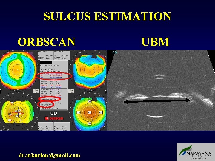 SULCUS ESTIMATION ORBSCAN dr. mkurian@gmail. com UBM 