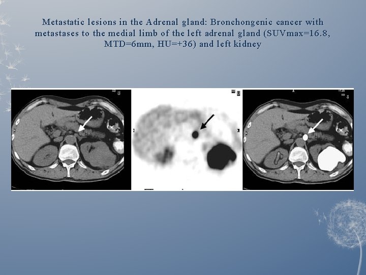 Metastatic lesions in the Adrenal gland: Bronchongenic cancer with metastases to the medial limb