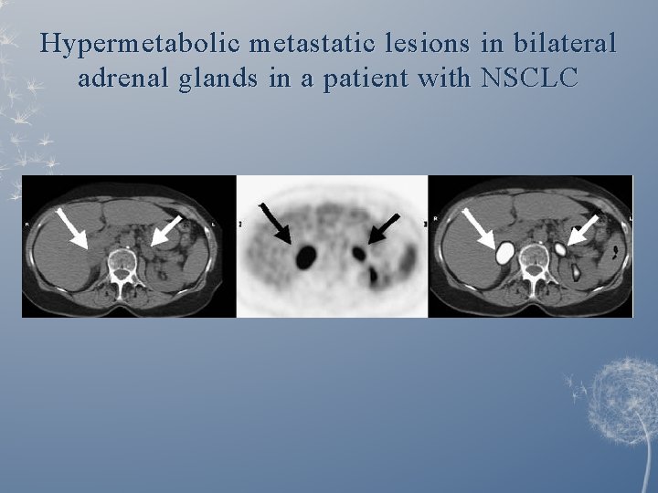 Hypermetabolic metastatic lesions in bilateral adrenal glands in a patient with NSCLC 