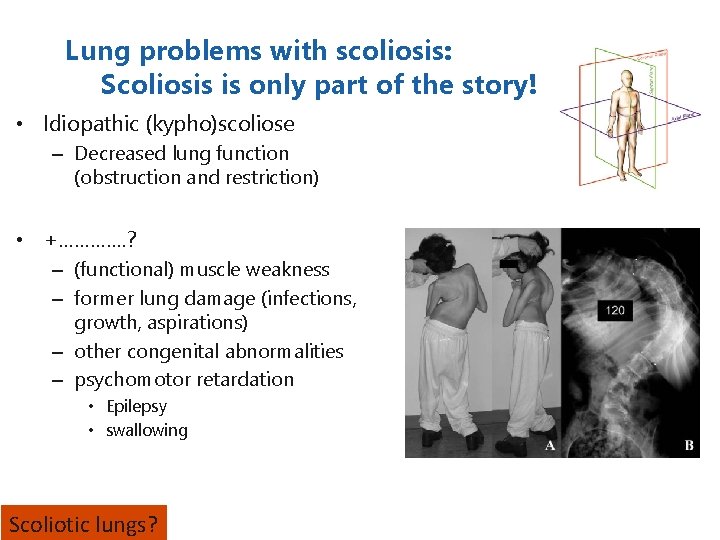 Lung problems with scoliosis: Scoliosis is only part of the story! • Idiopathic (kypho)scoliose