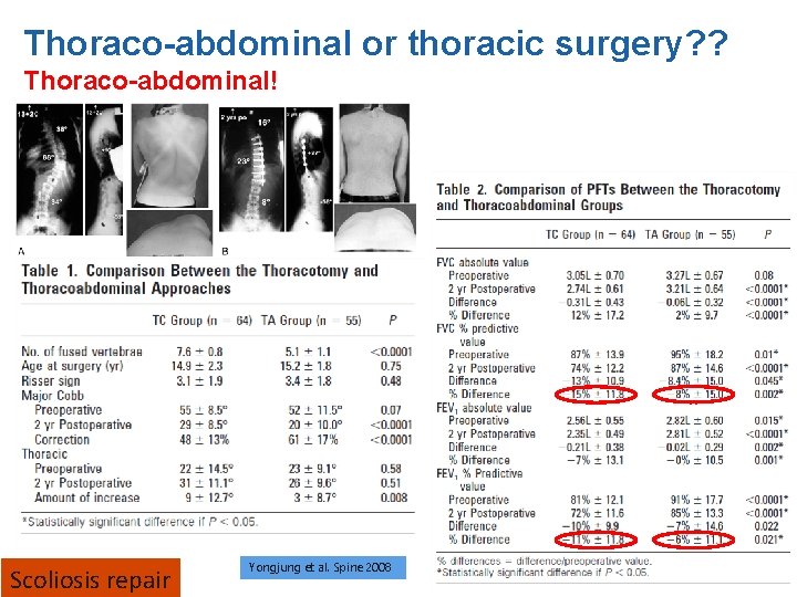 Thoraco-abdominal or thoracic surgery? ? Thoraco-abdominal! Scoliosis Kim et al repair 2007 Yongjung et