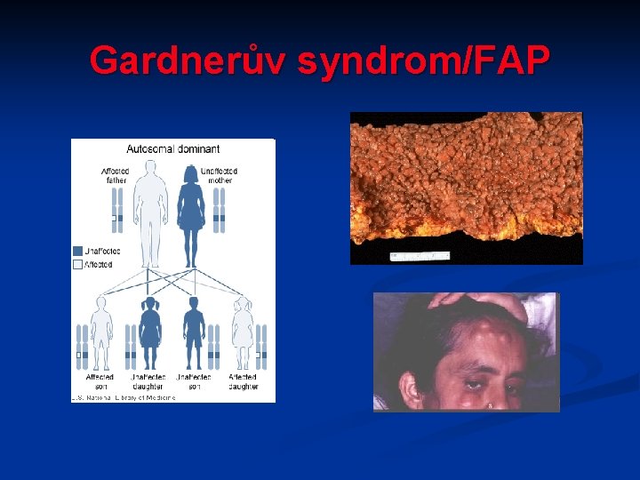 Gardnerův syndrom/FAP Gardnerův syndrom/FAP