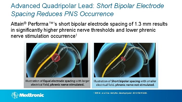 Advanced Quadripolar Lead: Short Bipolar Electrode Spacing Reduces PNS Occurrence Attain® Performa™’s short bipolar