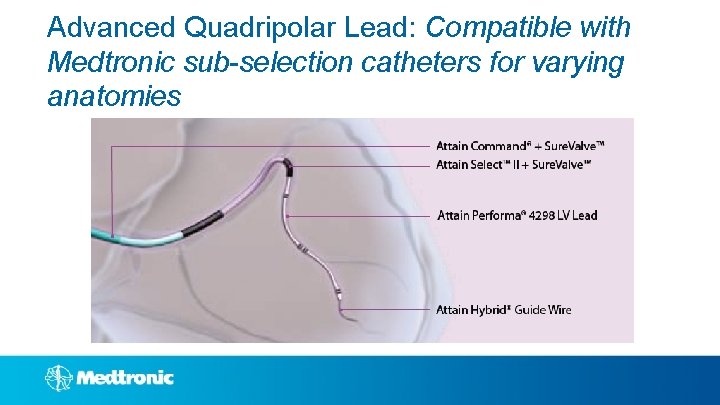 Advanced Quadripolar Lead: Compatible with Medtronic sub-selection catheters for varying anatomies 