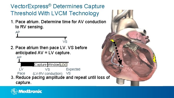 Vector. Express® Determines Capture Threshold With LVCM Technology 1. Pace atrium. Determine time for