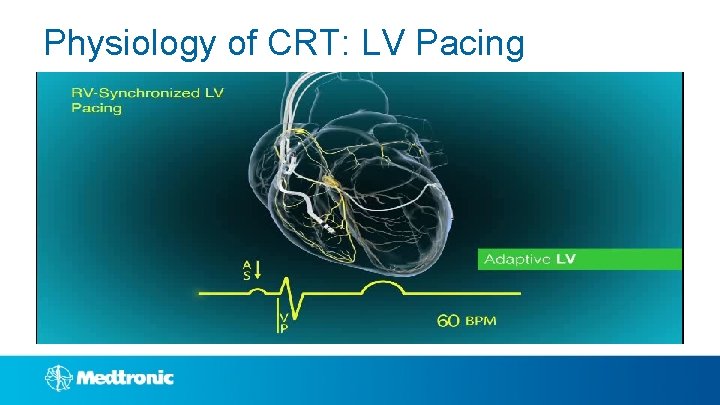 Physiology of CRT: LV Pacing 