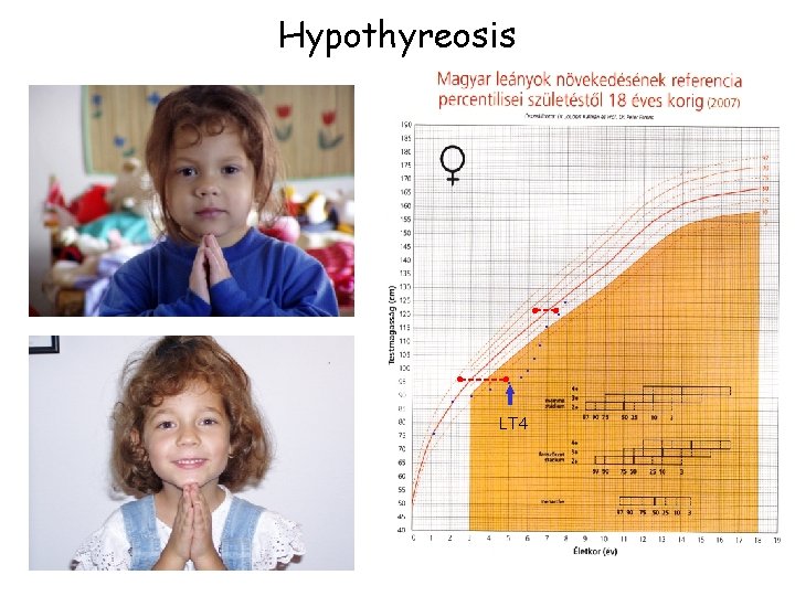 Hypothyreosis ● ● ● LT 4 rh. GH Hypothyreosis ● ● ● LT 4 rh. GH