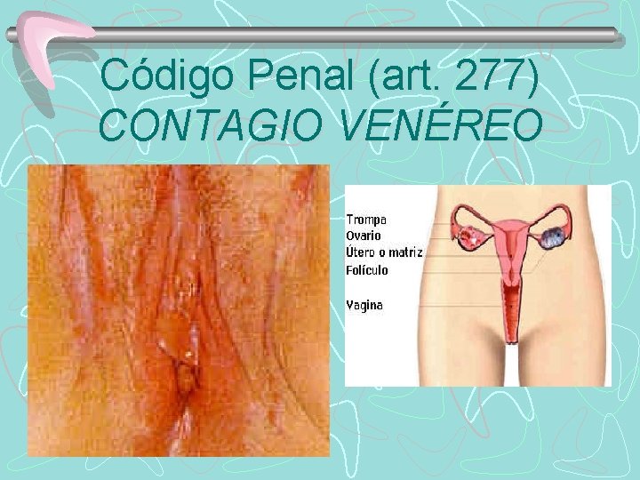 Código Penal (art. 277) CONTAGIO VENÉREO 