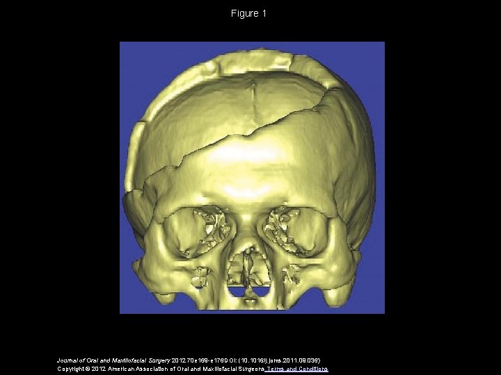 Figure 1 Journal of Oral and Maxillofacial Surgery 2012 70 e 169 -e 176