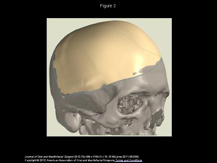 Figure 2 Journal of Oral and Maxillofacial Surgery 2012 70 e 169 -e 176