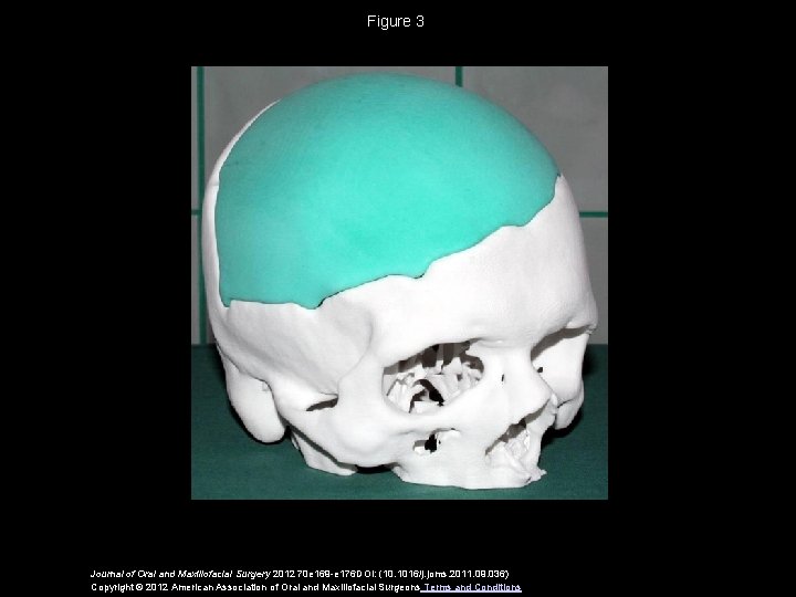 Figure 3 Journal of Oral and Maxillofacial Surgery 2012 70 e 169 -e 176