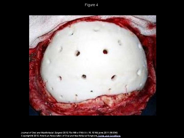 Figure 4 Journal of Oral and Maxillofacial Surgery 2012 70 e 169 -e 176