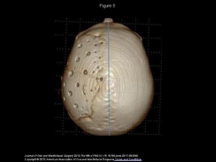 Figure 5 Journal of Oral and Maxillofacial Surgery 2012 70 e 169 -e 176