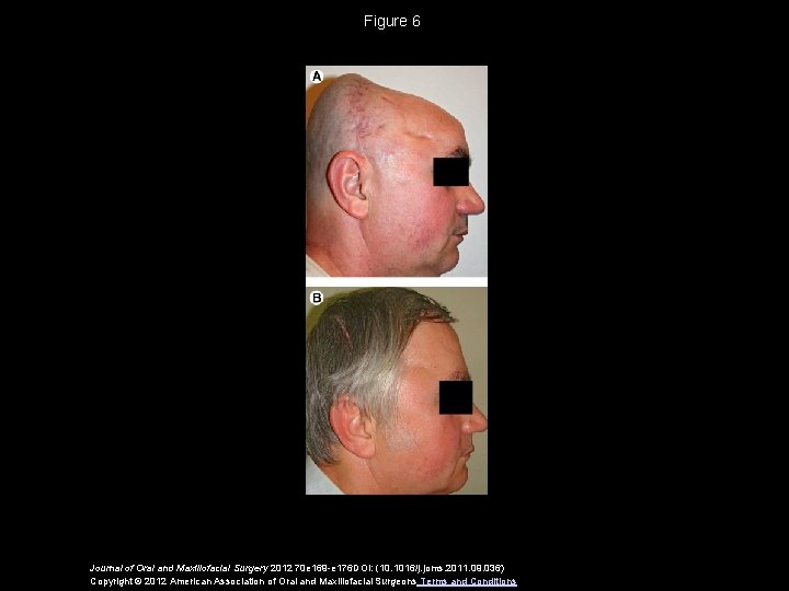 Figure 6 Journal of Oral and Maxillofacial Surgery 2012 70 e 169 -e 176