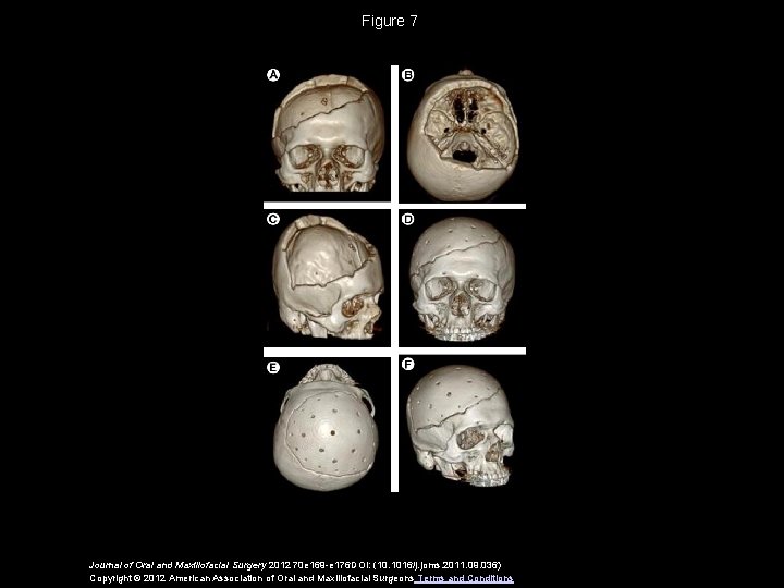 Figure 7 Journal of Oral and Maxillofacial Surgery 2012 70 e 169 -e 176