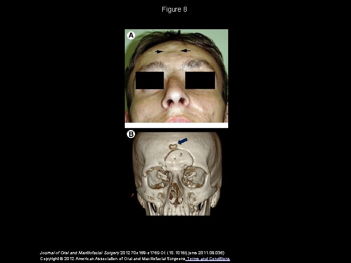 Figure 8 Journal of Oral and Maxillofacial Surgery 2012 70 e 169 -e 176