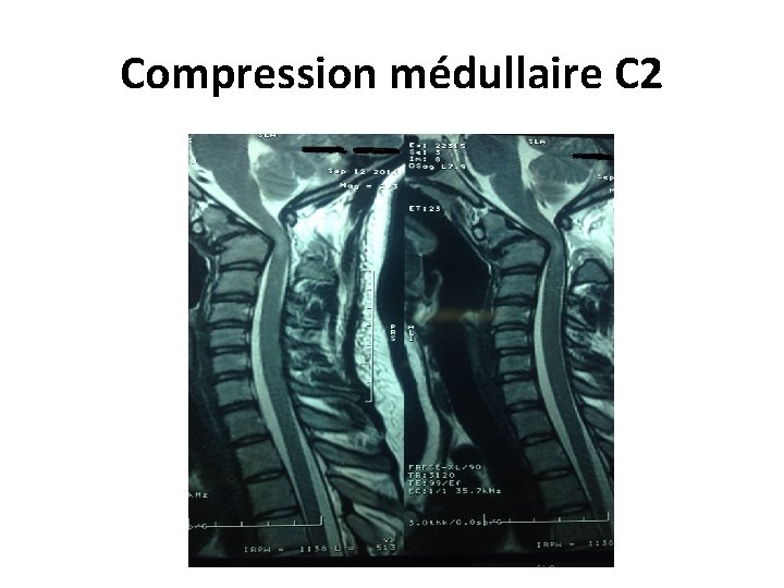 Compression médullaire C 2 