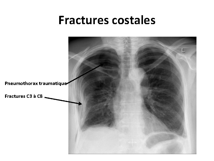 Fractures costales Pneumothorax traumatique Fractures C 3 à C 8 