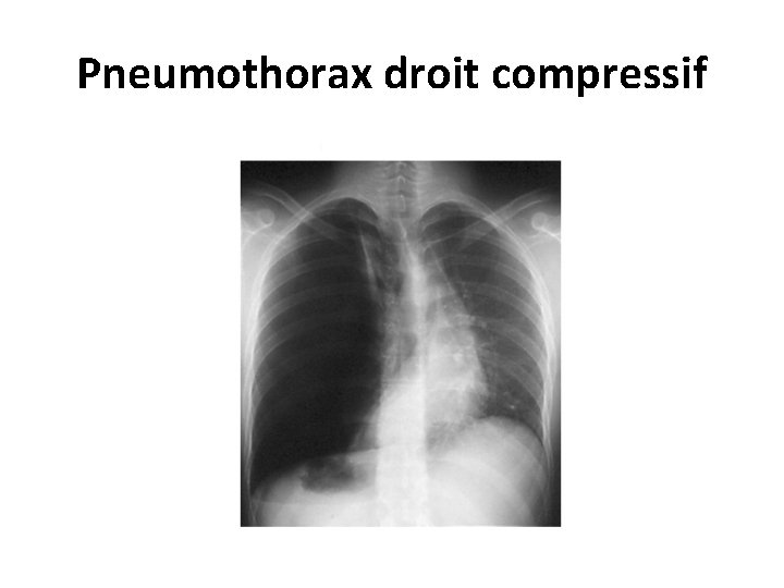 Pneumothorax droit compressif 