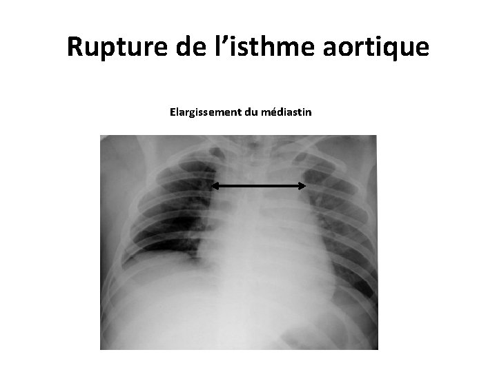 Rupture de l’isthme aortique Elargissement du médiastin 