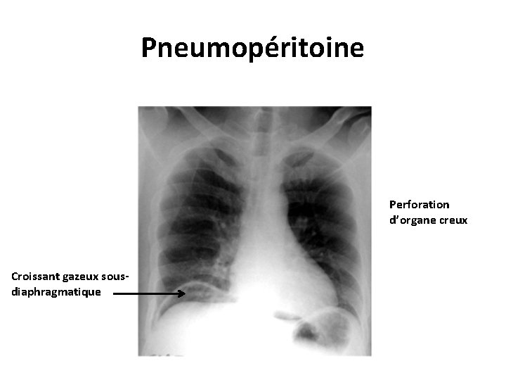 Pneumopéritoine Perforation d’organe creux Croissant gazeux sousdiaphragmatique 