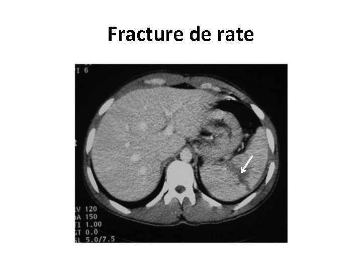 Fracture de rate 