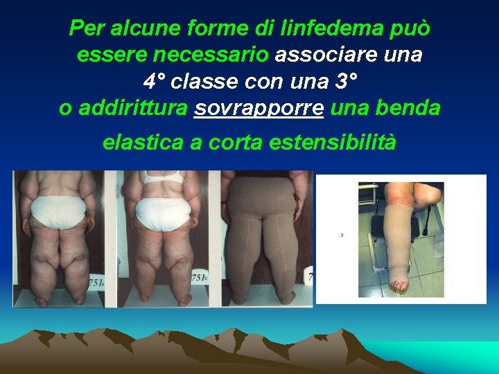 Per alcune forme di linfedema può essere necessario associare una 4° classe con una