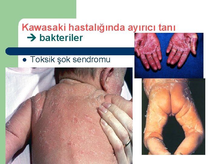 Kawasaki hastalığında ayırıcı tanı bakteriler l Toksik şok sendromu 