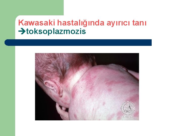 Kawasaki hastalığında ayırıcı tanı toksoplazmozis Kawasaki hastalığında ayırıcı tanı toksoplazmozis
