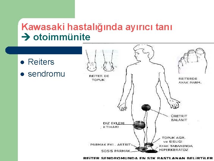 Kawasaki hastalığında ayırıcı tanı otoimmünite l l Reiters sendromu 