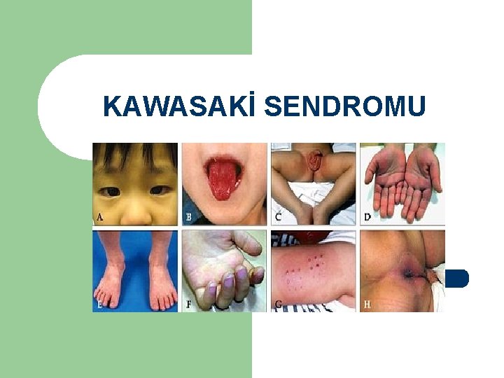 KAWASAKİ SENDROMU 