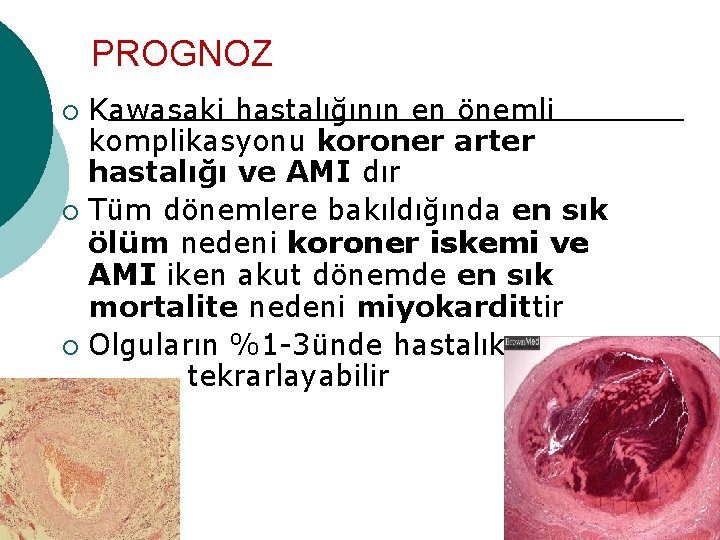 PROGNOZ Kawasaki hastalığının en önemli komplikasyonu koroner arter hastalığı ve AMI dır ¡ Tüm PROGNOZ Kawasaki hastalığının en önemli komplikasyonu koroner arter hastalığı ve AMI dır ¡ Tüm